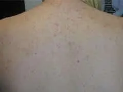 Back Acne Treatment Los Angeles CA
