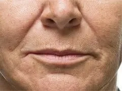 Before Image of Dermal Fillers Los Angeles CA