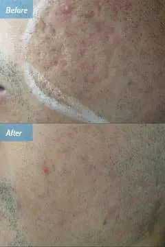 Laser Skin Resurfacing Procedure Los Angeles CA