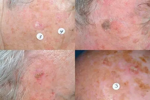 Actinic Keratoses Los Angeles CA