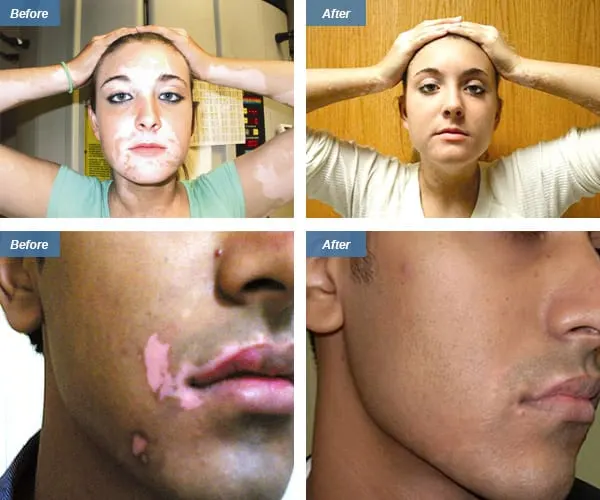 Before & After Excimer Laser Therapy Los Angeles CA