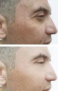 Before & After Image of Cosmetic Treatments For Men Los Angeles CA