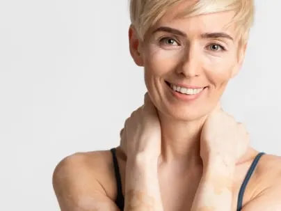 Excimer Laser Therapy Los Angeles CA