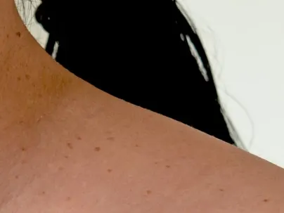 Skin Tag Treatment Los Angeles CA