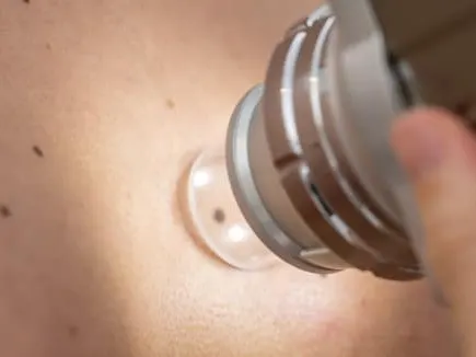 Photodynamic Therapy Los Angeles CA