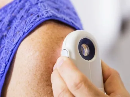 Electrodesiccation and Curettage Treatment Los Angeles CA