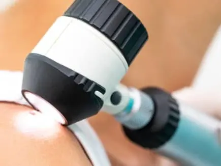 Melanoma Treatment Los Angeles CA