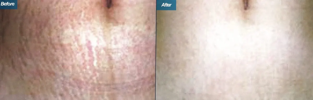 Micro-Needling Treatment Los Angeles CA