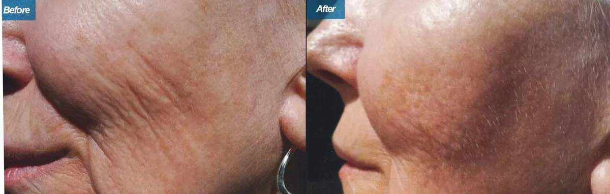 Micro-Needling Procedure Los Angeles CA