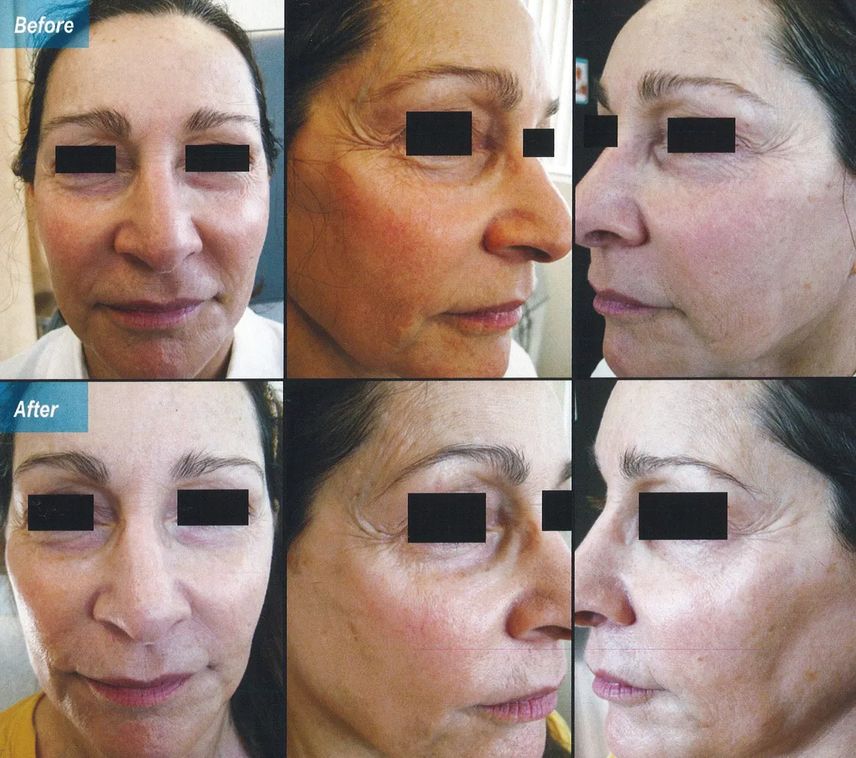 Before & After Image of Chemical Peels Los Angeles CA