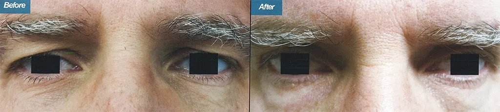 Before & After Image of Blepharoplasty Los Angeles CA