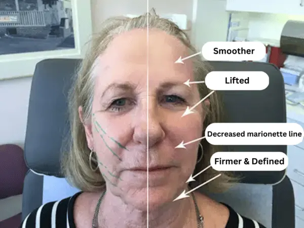 SBC’s Rejuvenation Thread Lift Treatment Los Angeles CA