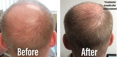 Before & After Image of Skin Rejuvenation Los Angeles CA