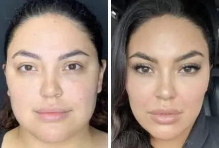 Before and After Lip Augmentation Los Angeles CA
