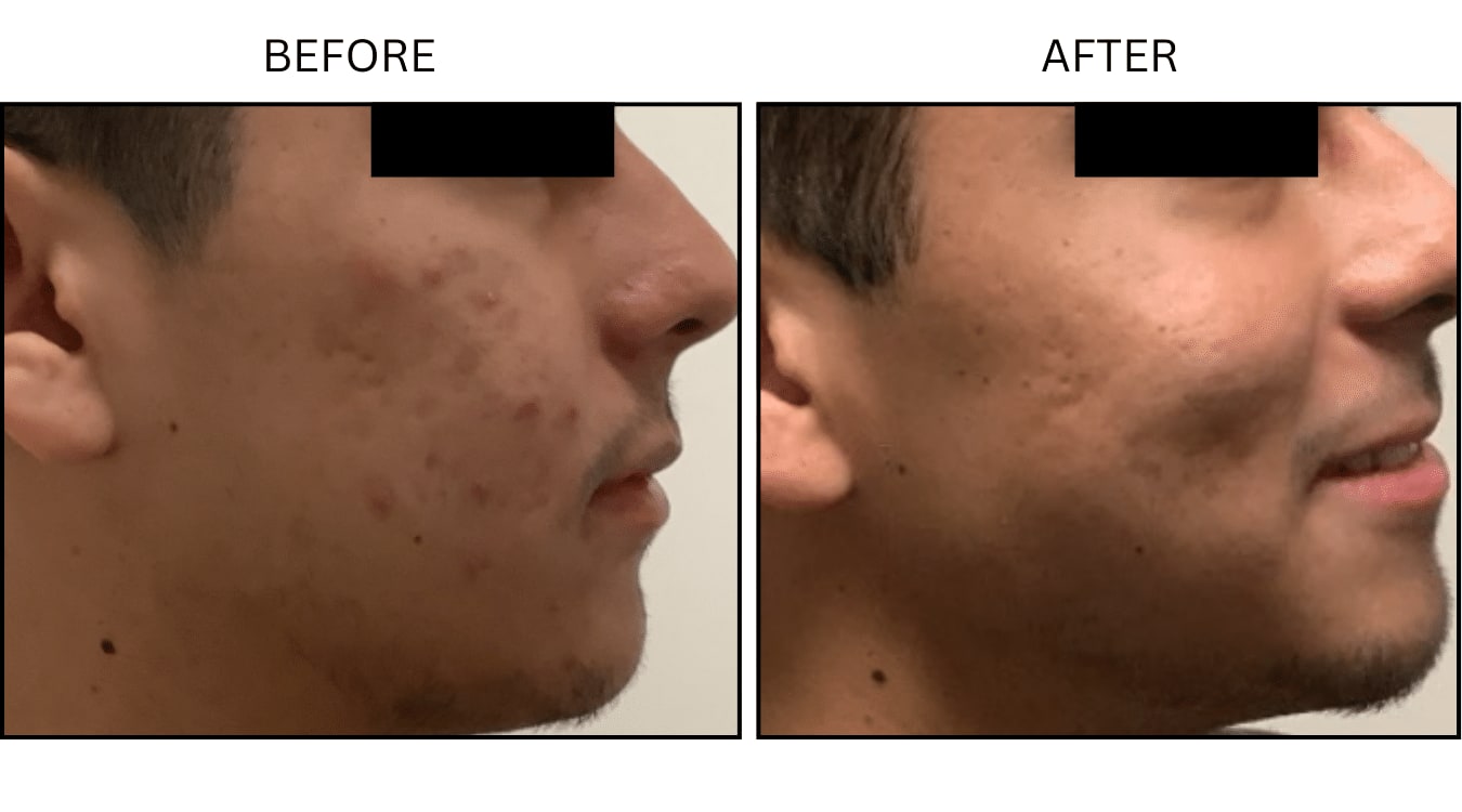 Acne (Medical), before and after photograph 24