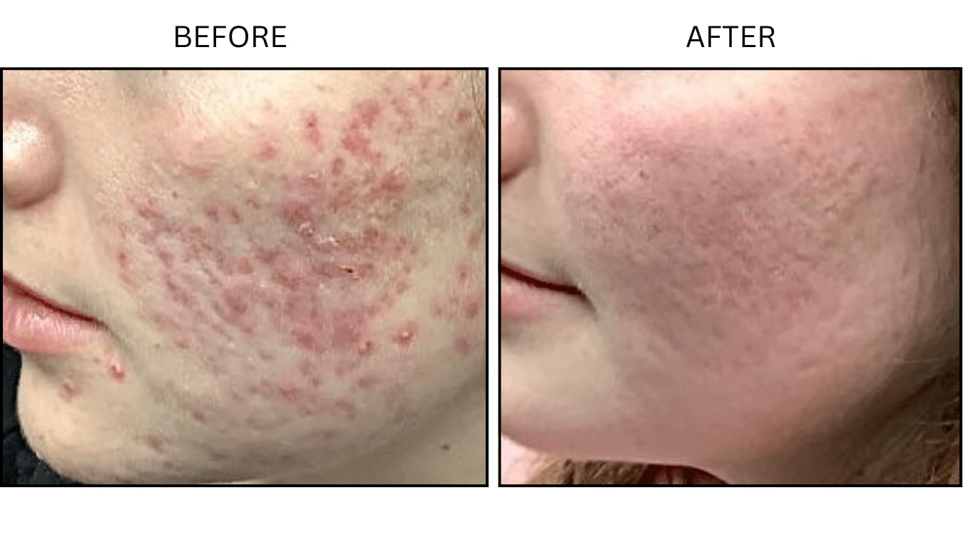Acne (Medical), before and after photograph 16