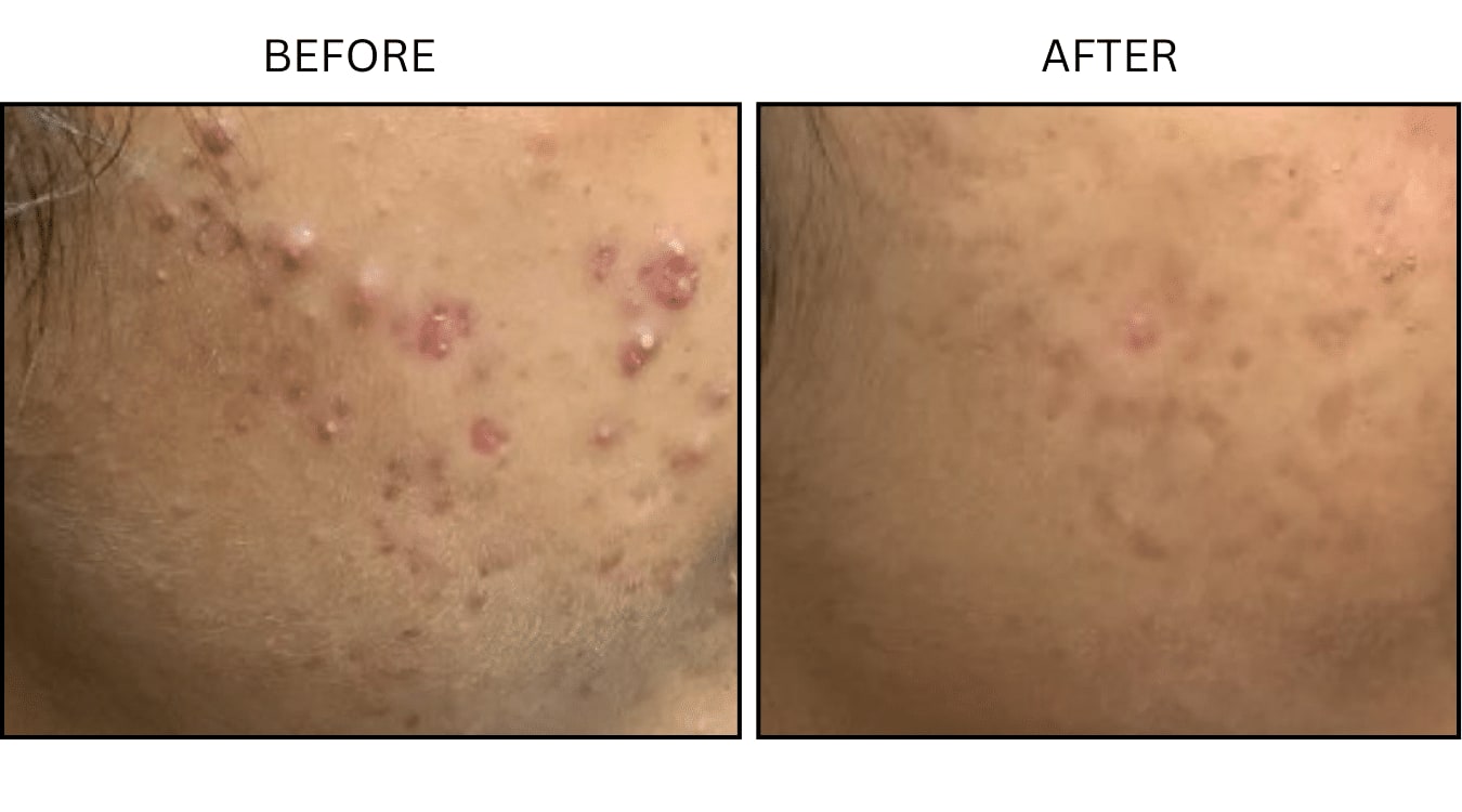 Acne (Medical), before and after photograph 17