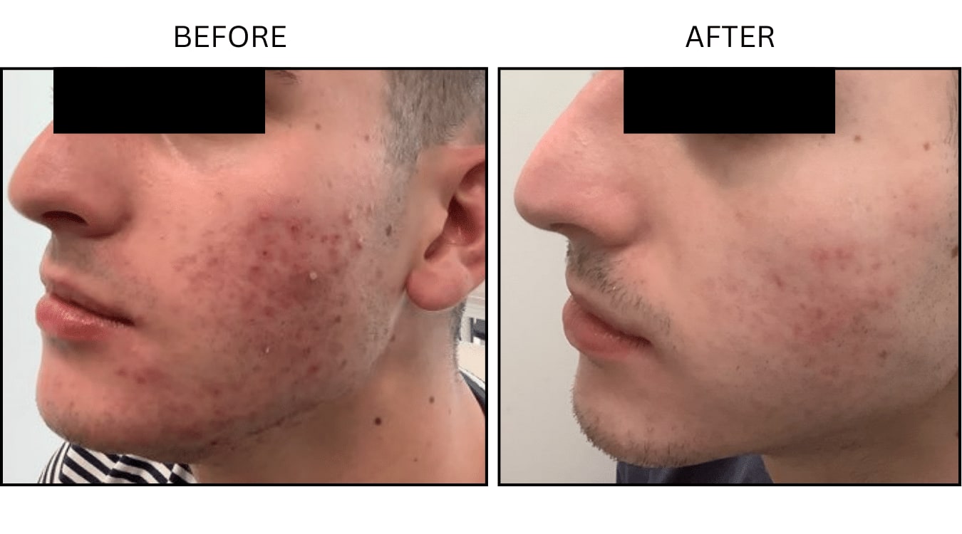 Acne (Medical), before and after photograph 18
