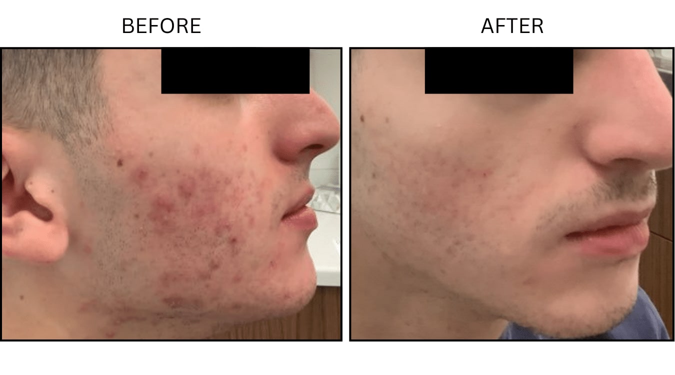 Acne (Medical), before and after photograph 19