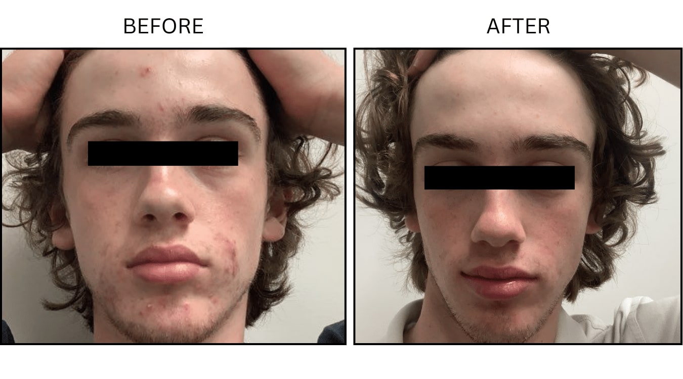 Acne (Medical), before and after photograph 20