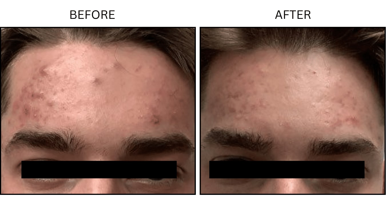 Acne (Medical), before and after photograph 21