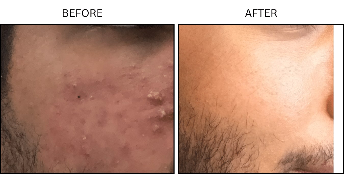 Acne (Medical), before and after photograph 22