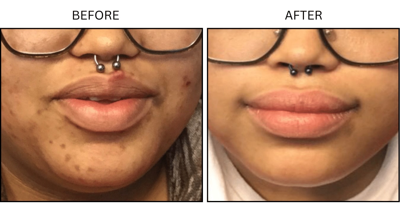 Acne (Medical), before and after photograph 23