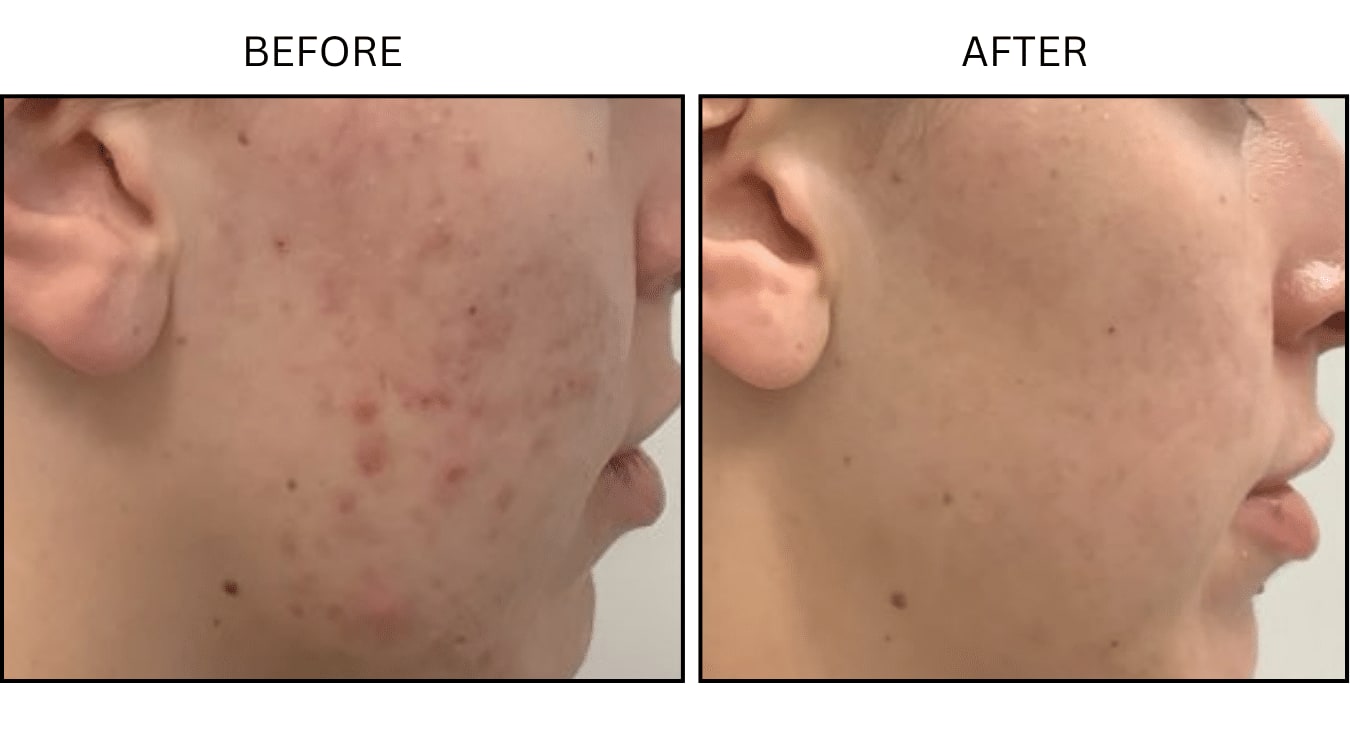 Acne (Medical), before and after photograph 25