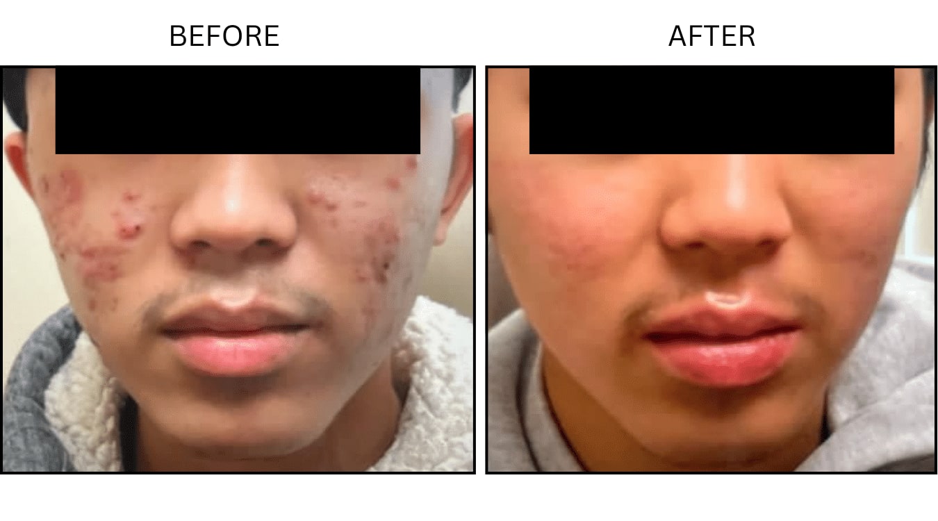 Acne (Medical), before and after photograph 1