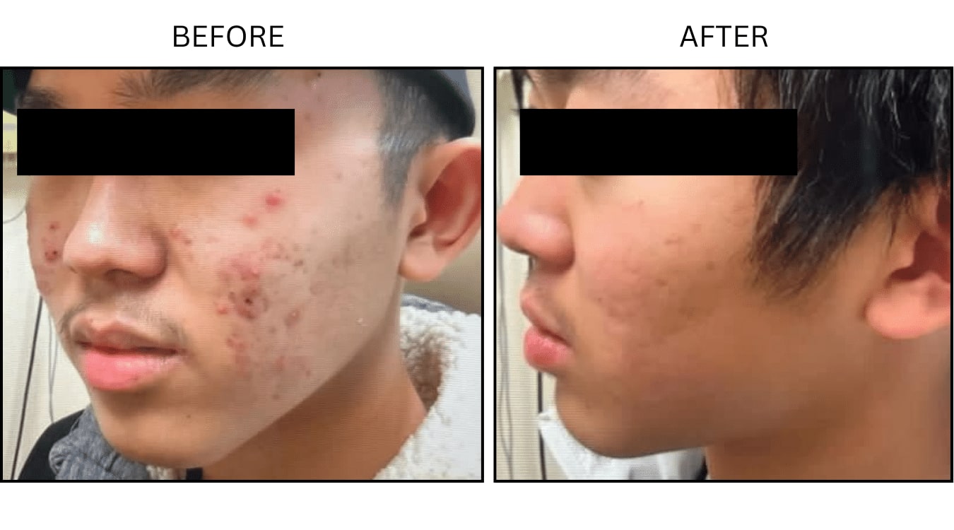 Acne (Medical), before and after photograph 2