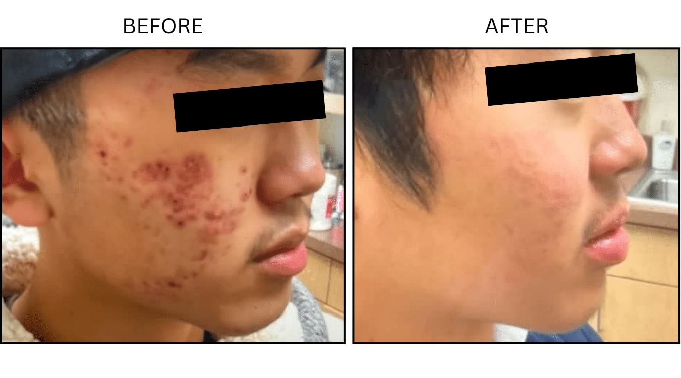 Acne (Medical), before and after photograph 3