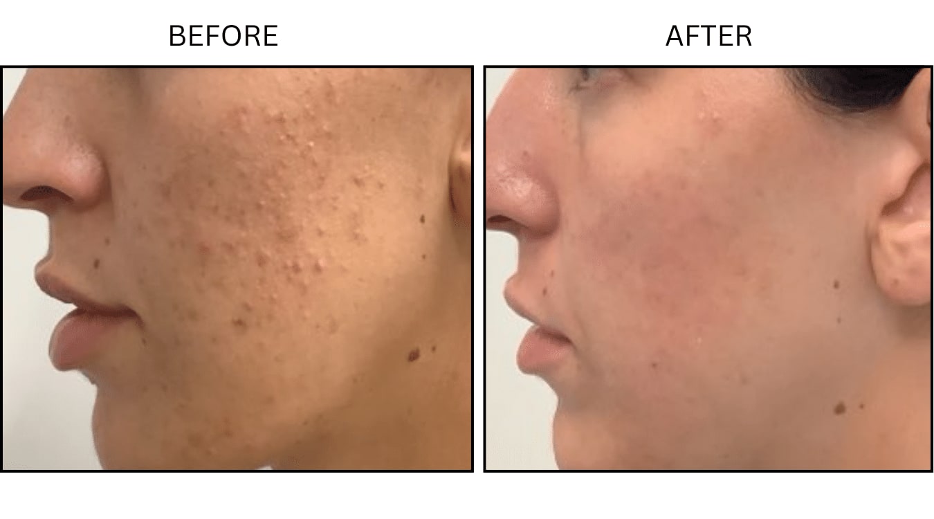 Acne (Medical), before and after photograph 26