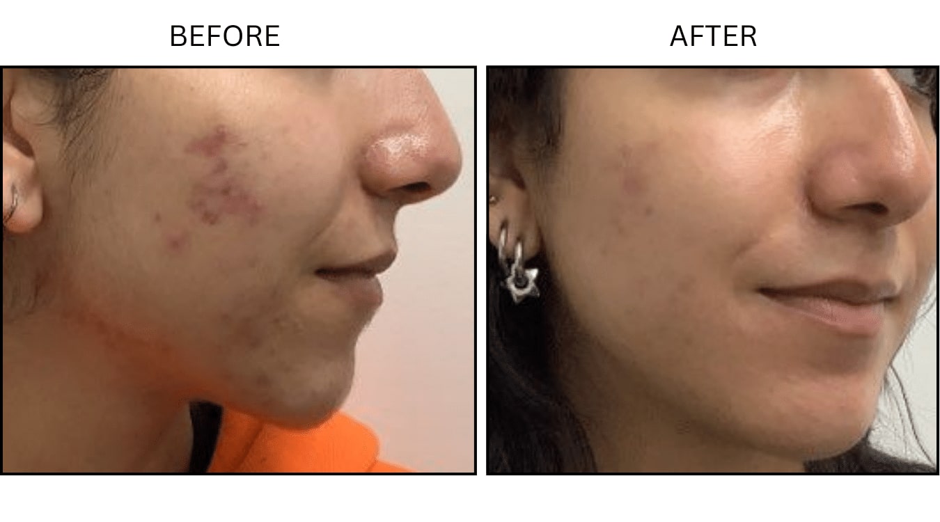 Acne (Medical), before and after photograph 4