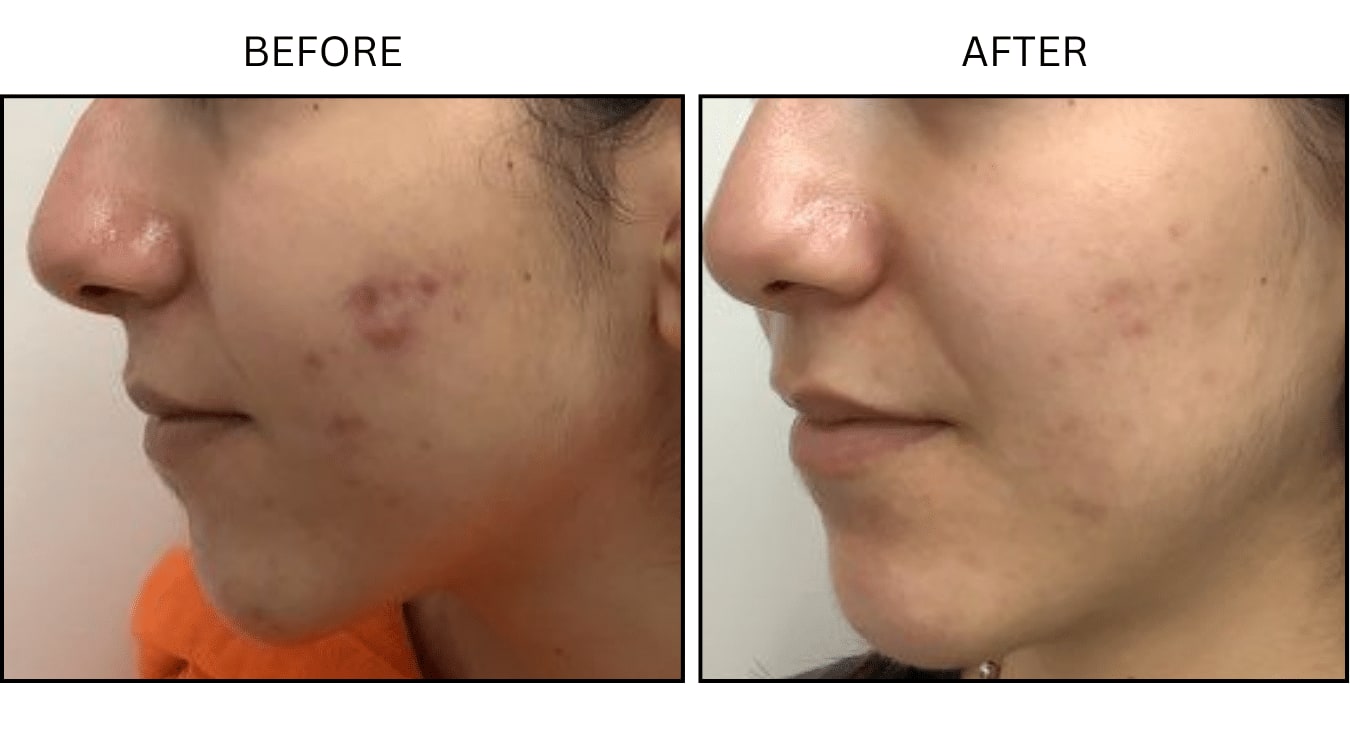 Acne (Medical), before and after photograph 5
