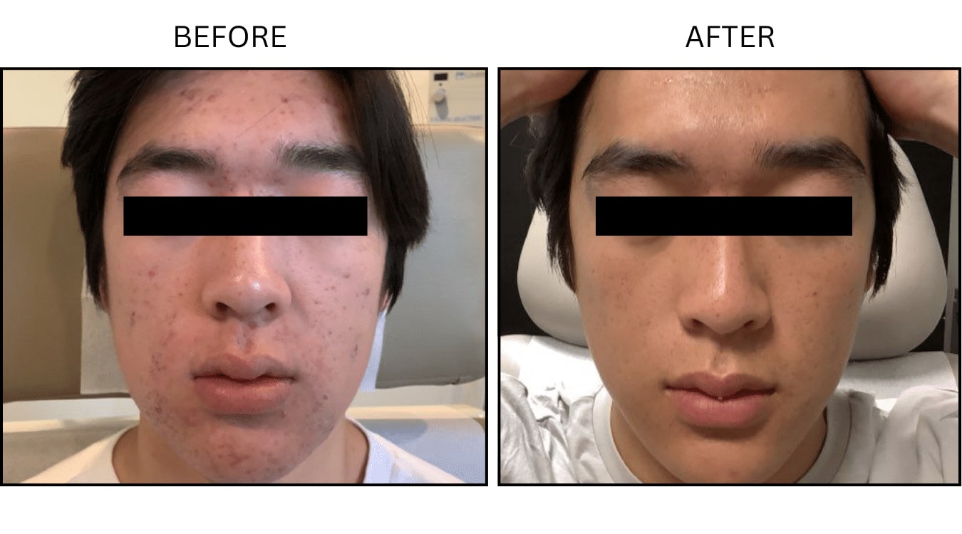 Acne (Medical), before and after photograph 6