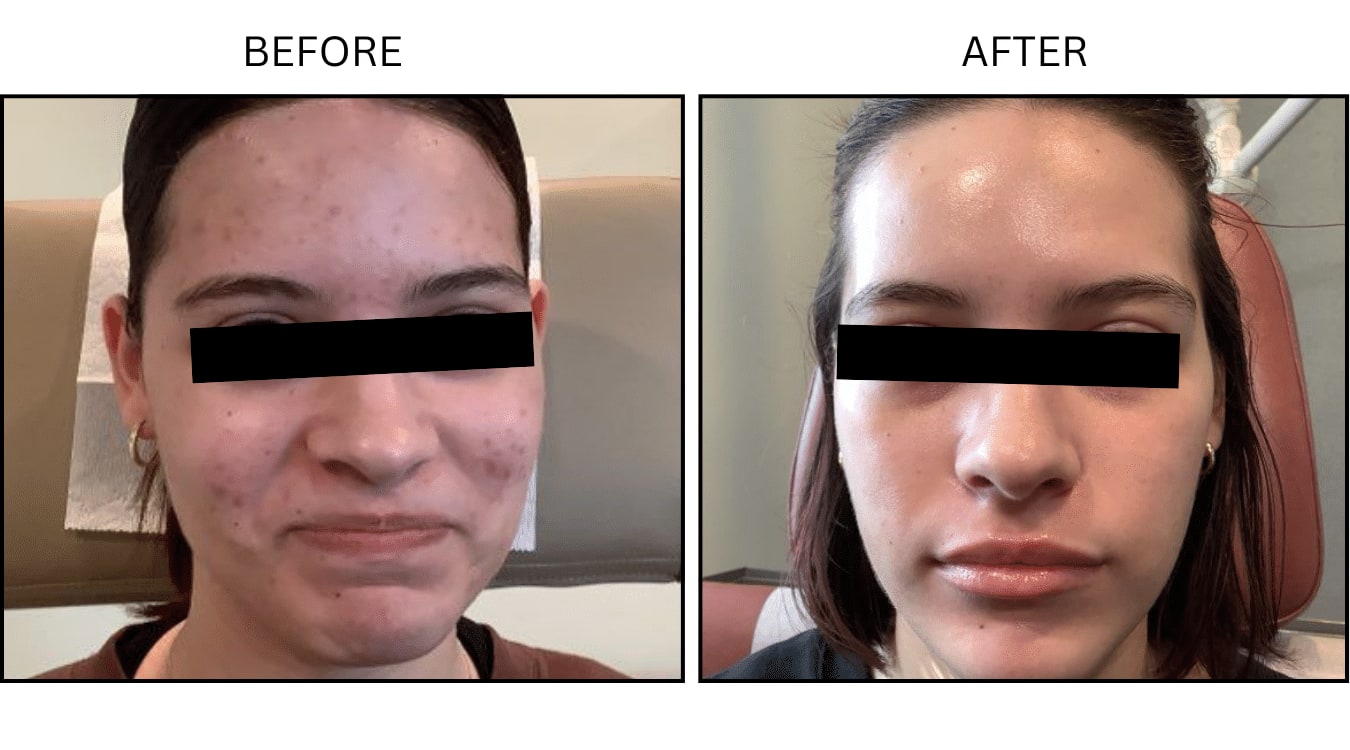 Acne (Medical), before and after photograph 7