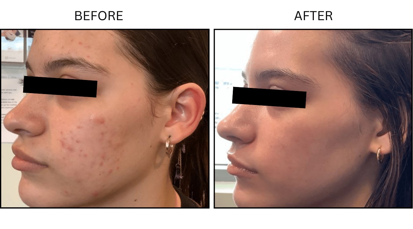 Acne (Medical), before and after photograph 8