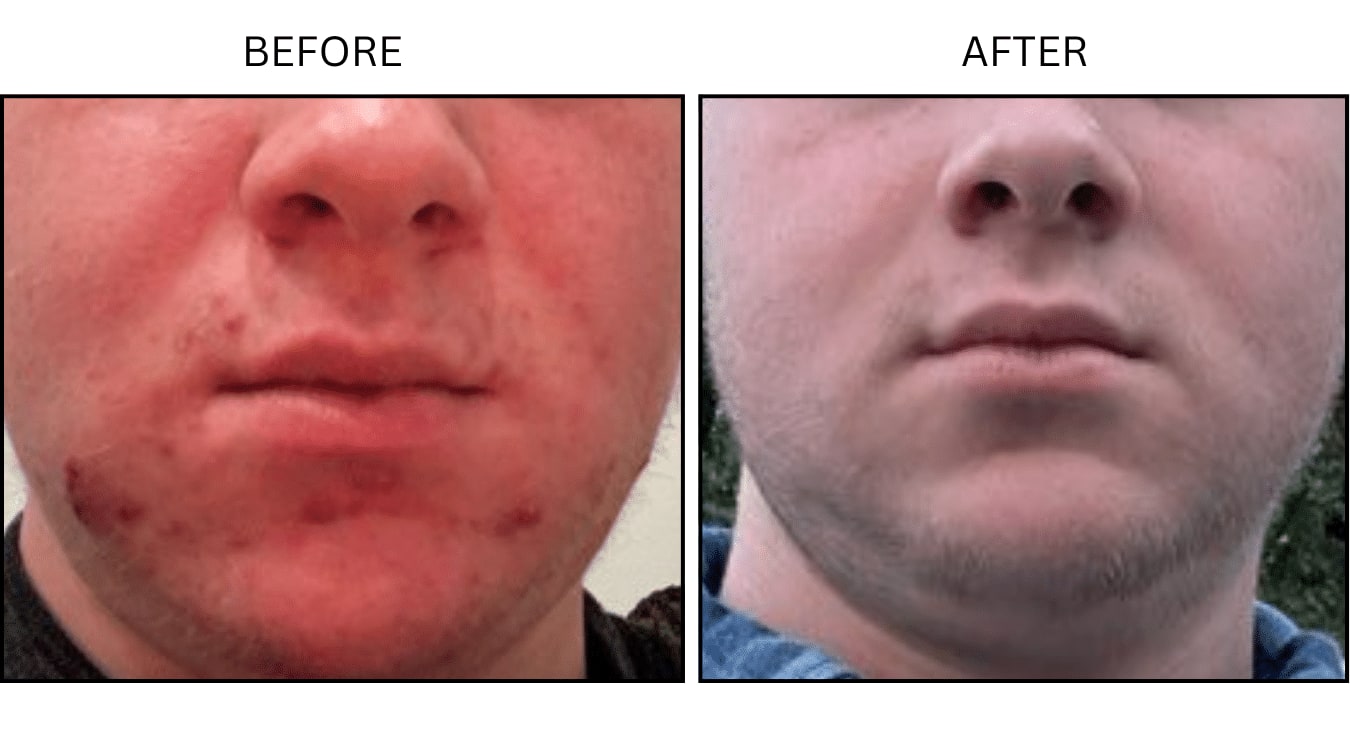 Acne (Medical), before and after photograph 9