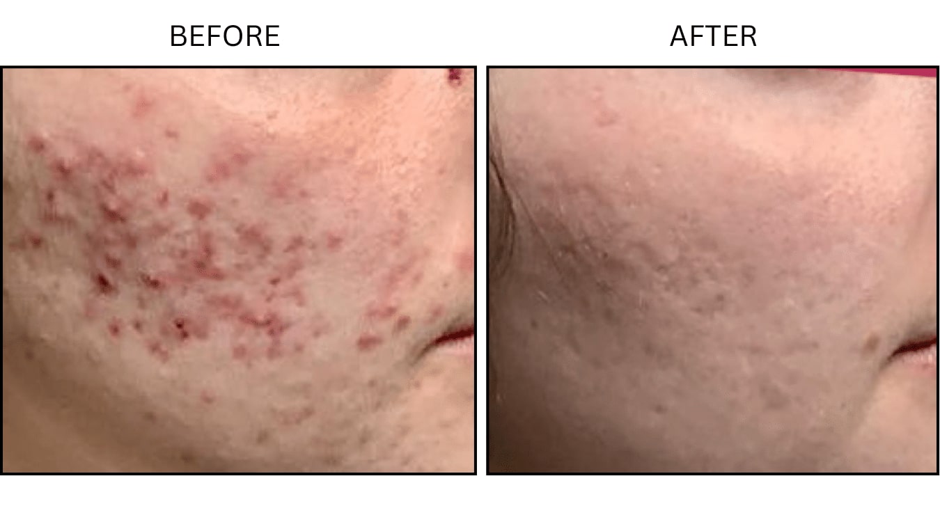 Acne (Medical), before and after photograph 10