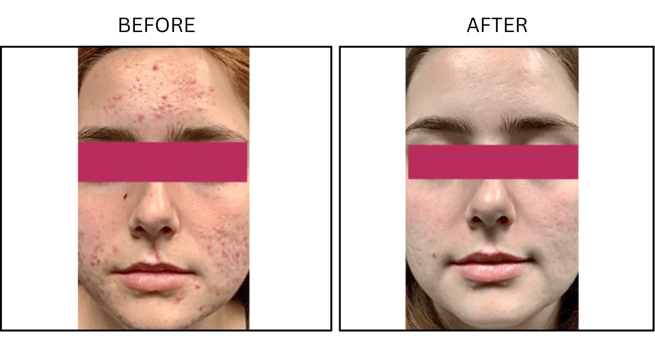 Acne (Medical), before and after photograph 11