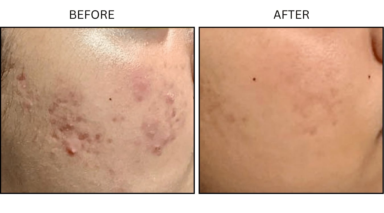 Acne (Medical), before and after photograph 12