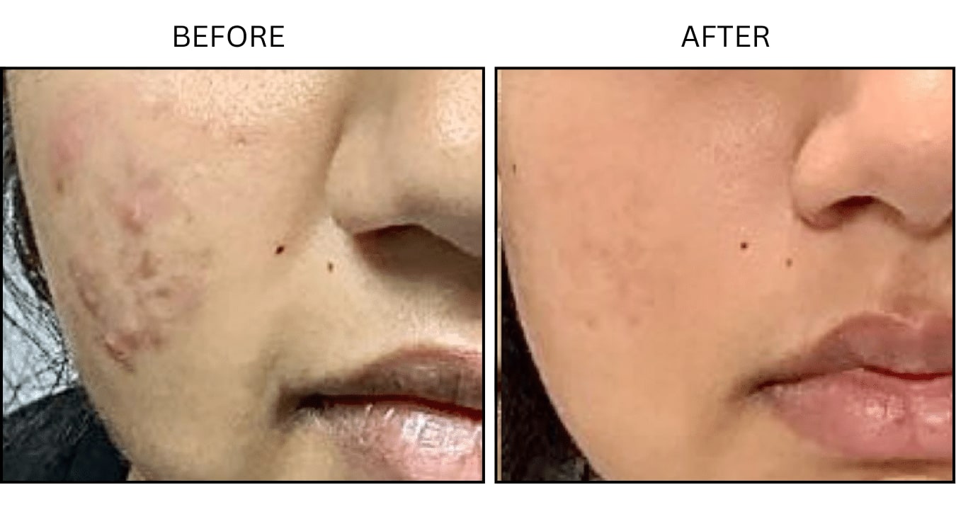 Acne (Medical), before and after photograph 13