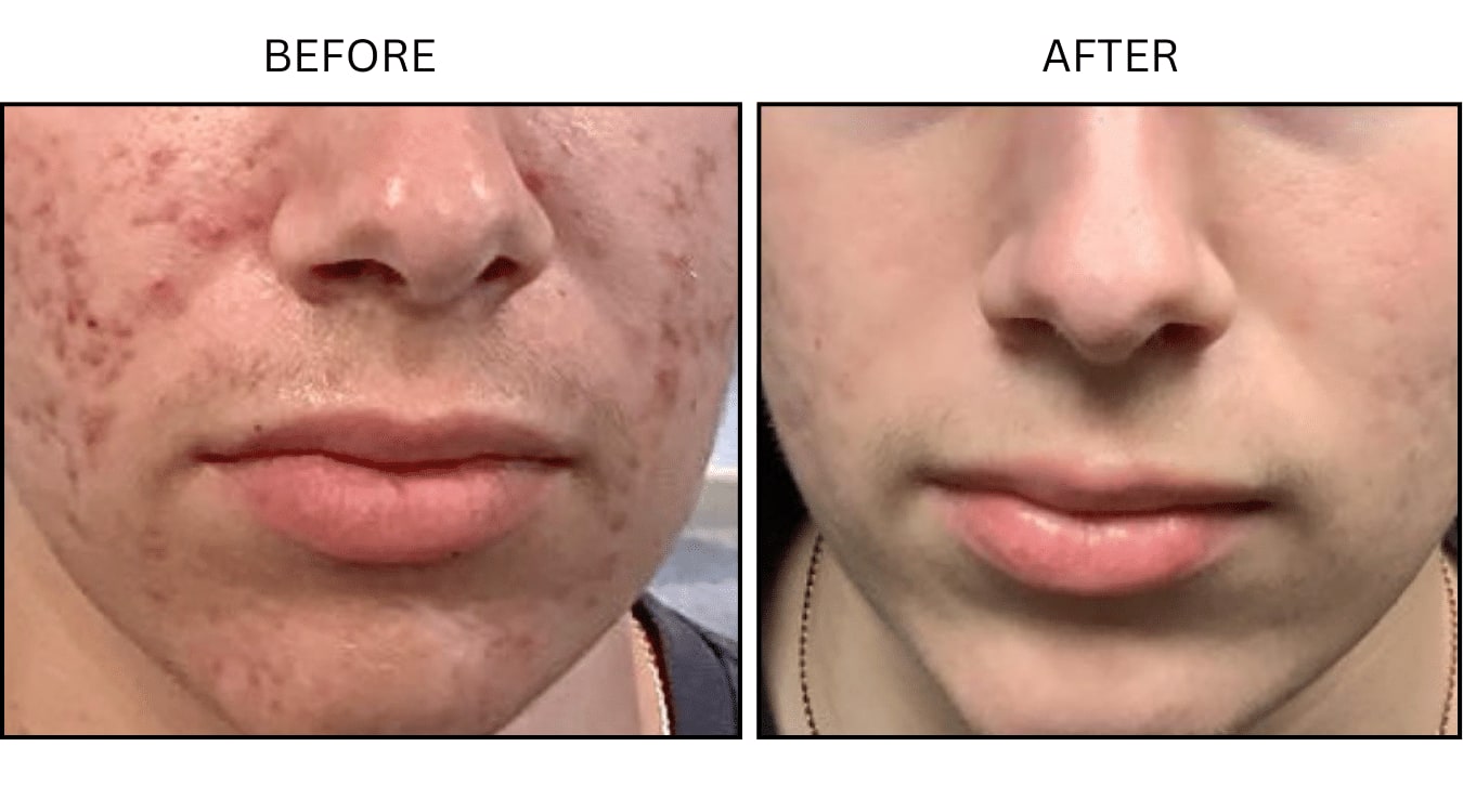 Acne (Medical), before and after photograph 14