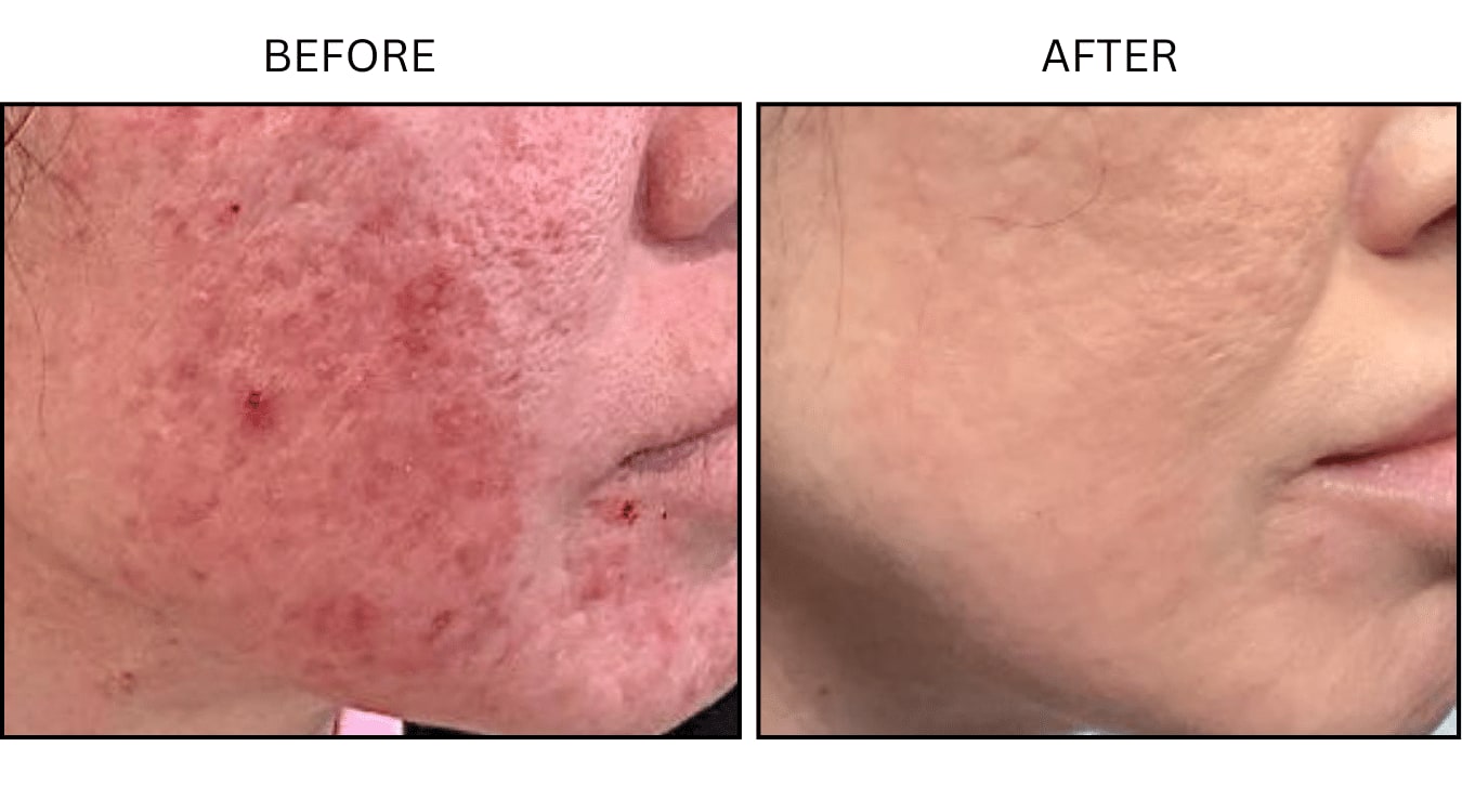 Acne (Medical), before and after photograph 15