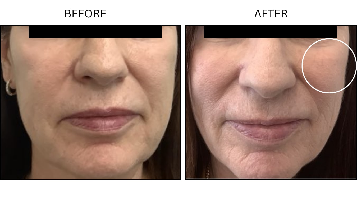 Cheeks (Fillers), before and after photograph 6