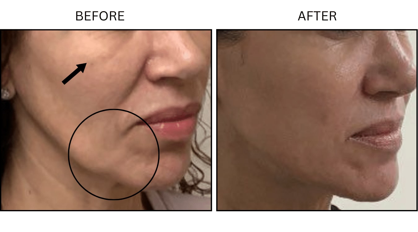 Cheeks (Fillers), before and after photograph 1