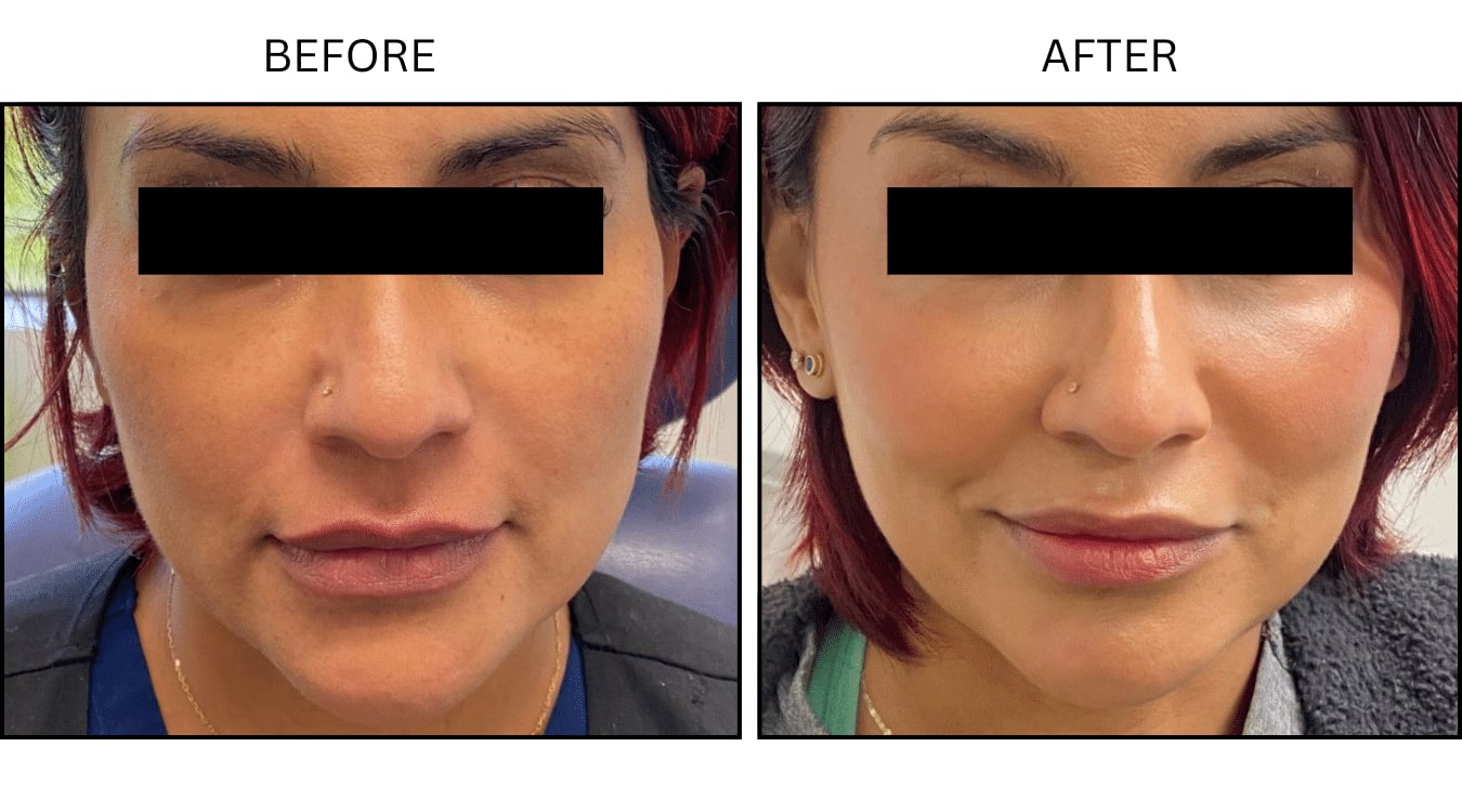Cheeks (Fillers), before and after photograph 4