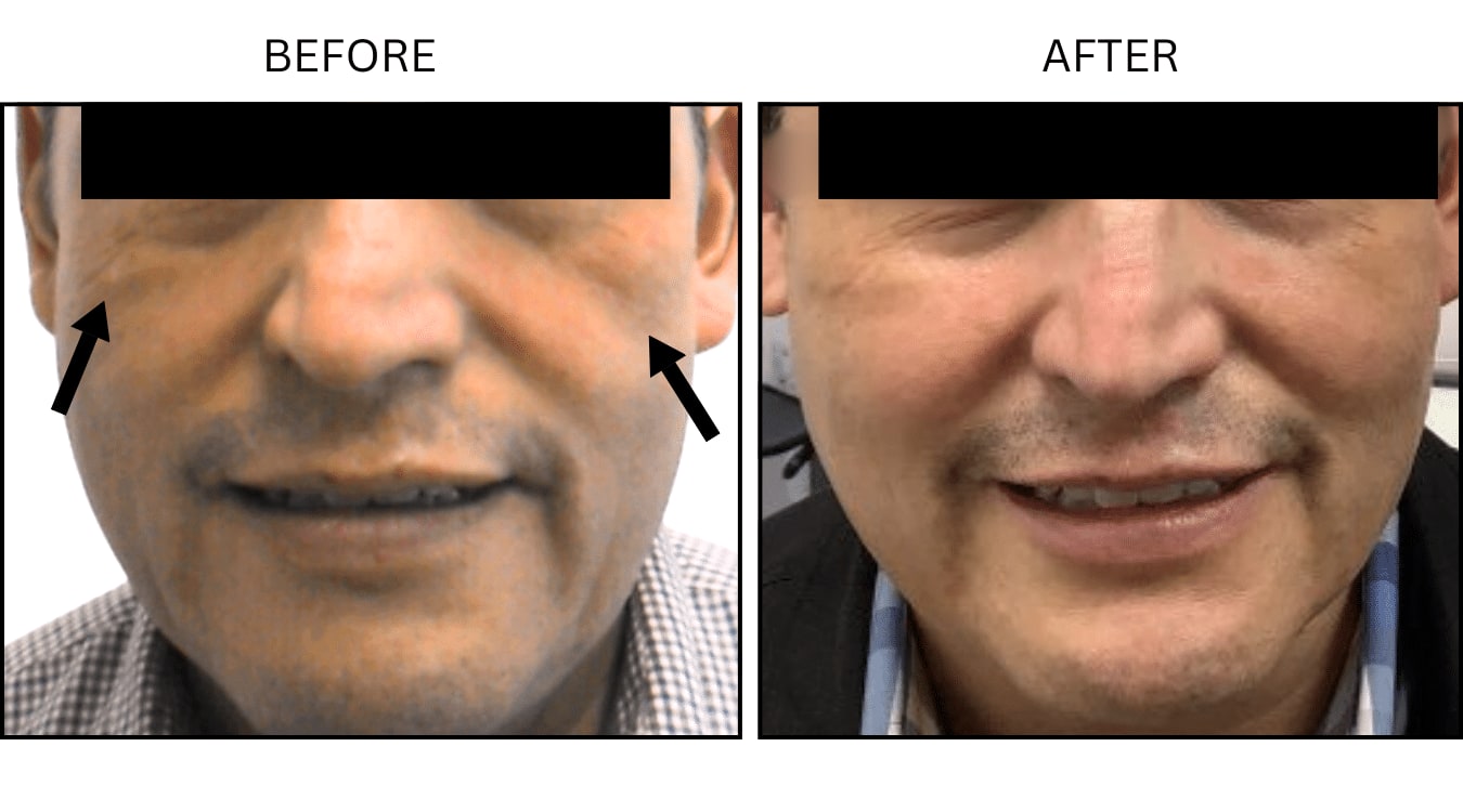Cheeks (Fillers), before and after photograph 5