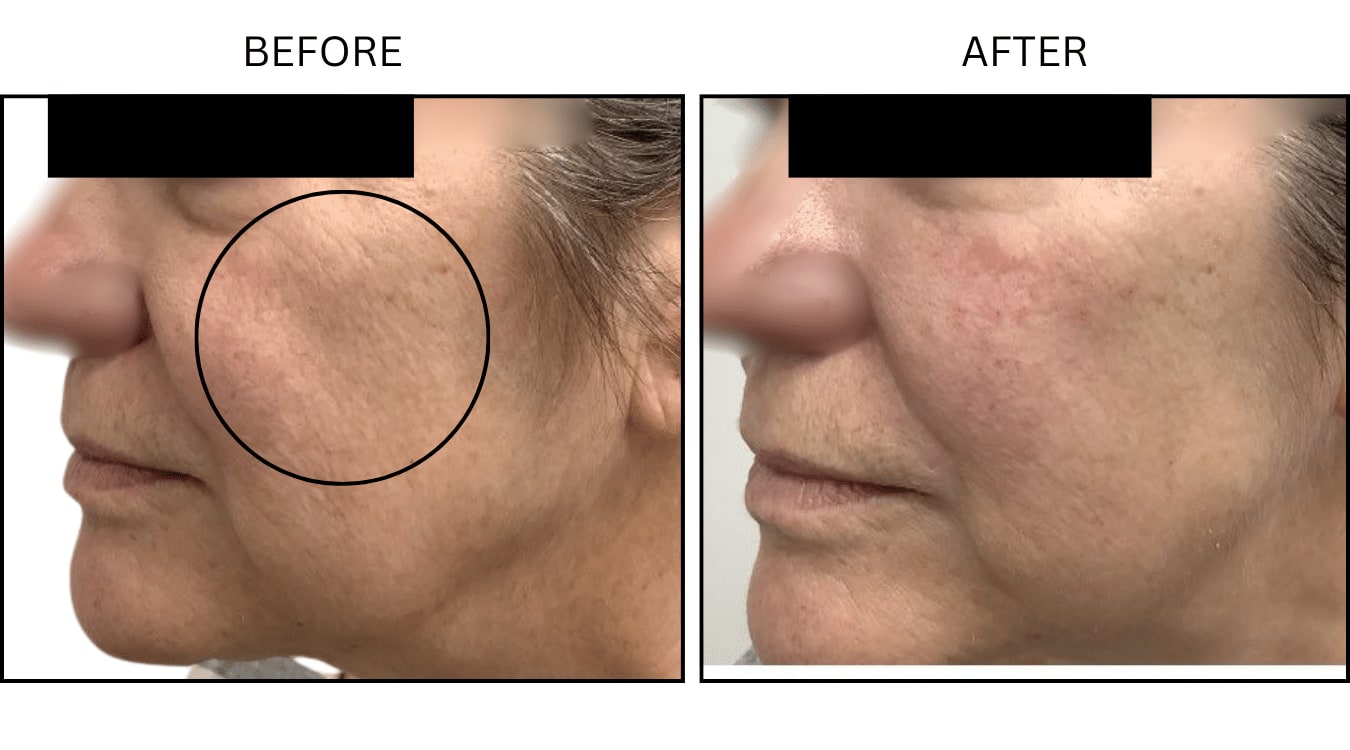 Cheeks (Fillers), before and after photograph 3