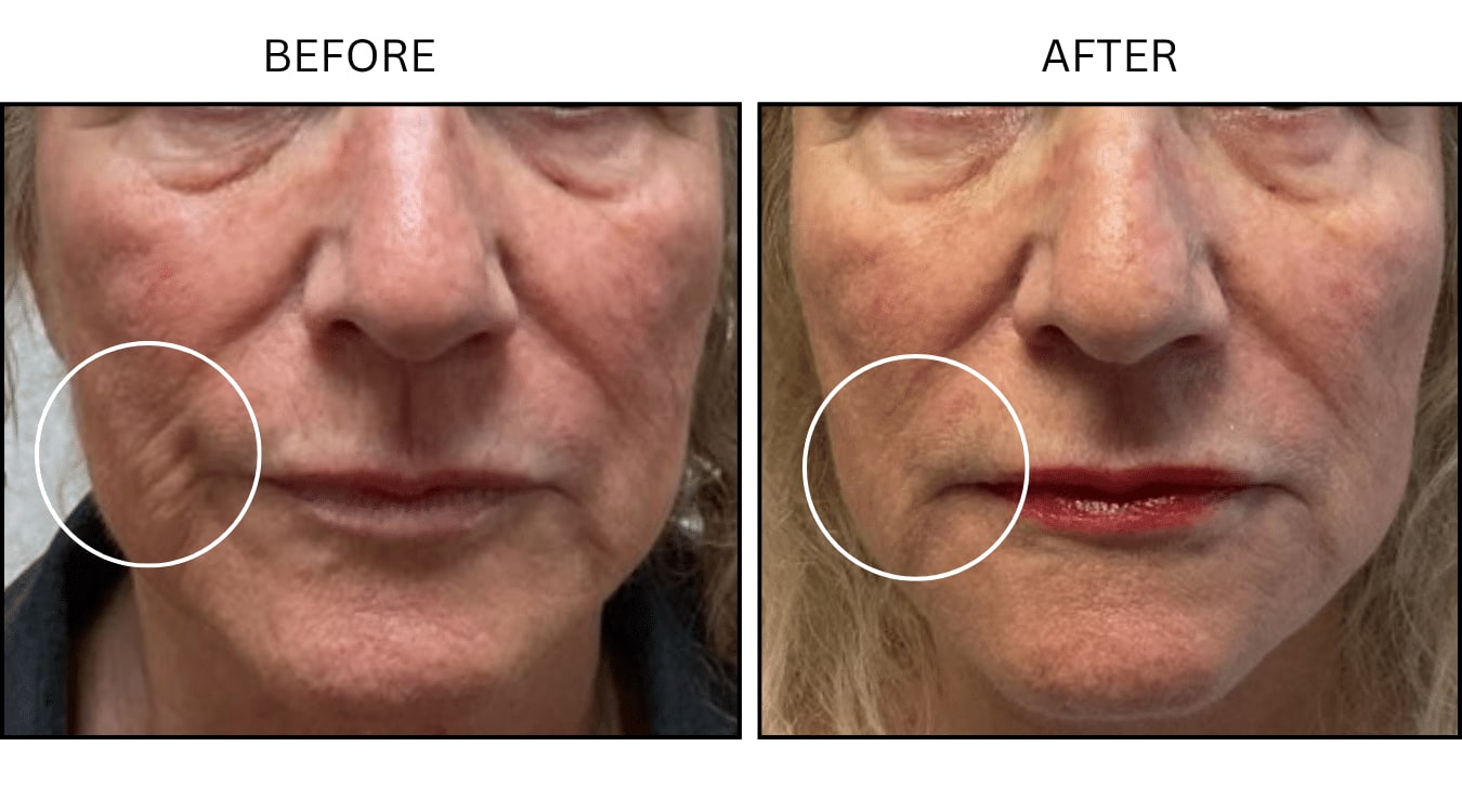 Cheeks (Fillers), before and after photograph 7